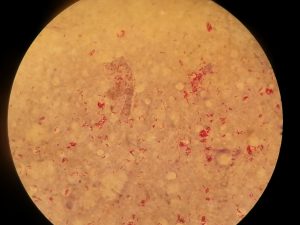 Red-bacilli-single-clump-and-globi-in-Ziehl-Nielsen-cold-stained-smear-of-skin