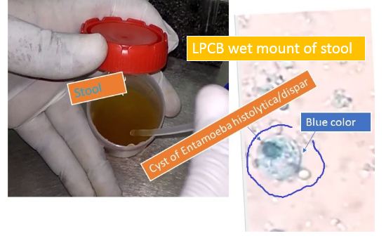 Cyst of Entamoeba histolytica or dispar on LPCB wet mount of stool