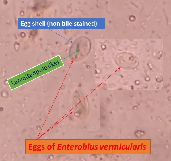 enterobius vermicularis in stool)