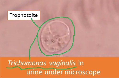 Trichomonas urethra)