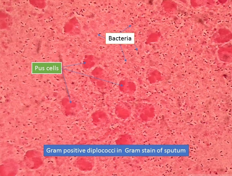 Gram positive diplococci in Gram stain of sputum