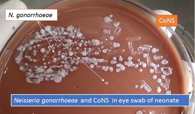 Neisseria gonorrhoeae and Cons in eye swab of neonate