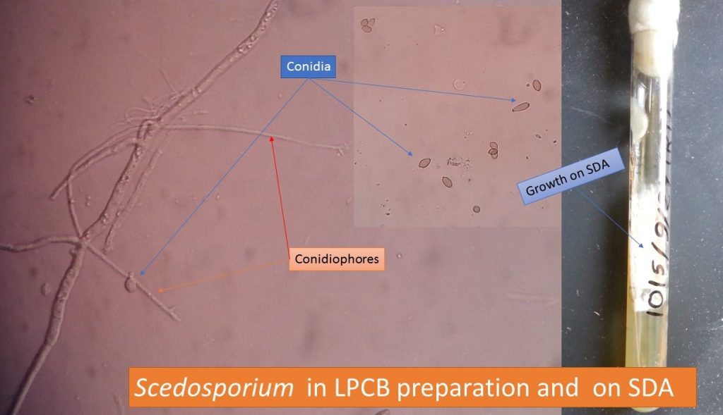 Scedosporium in LPCB preparation and on SDA