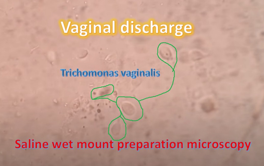 Trichomonas a WC-ben. Ilyen fertőzéseket kaphatsz el a nyilvános WC-kben