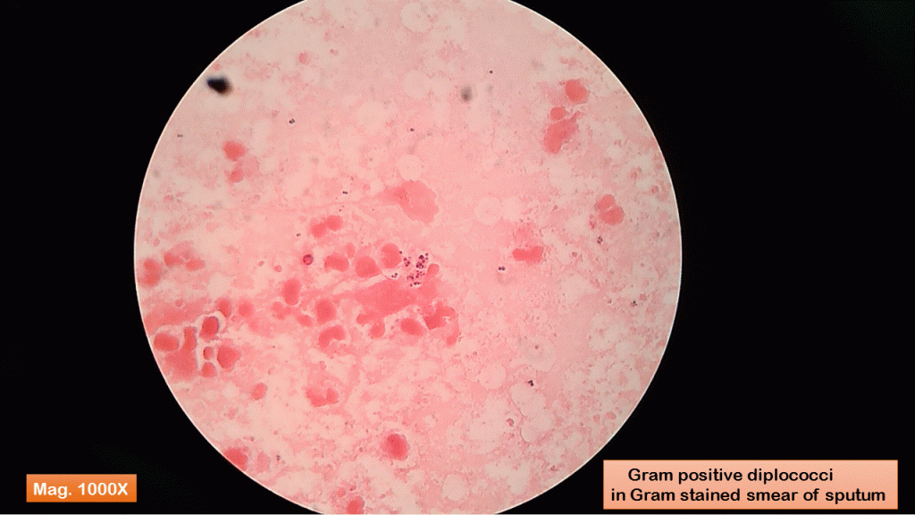 Gram positive diplococci in Gram stained smear of sputum