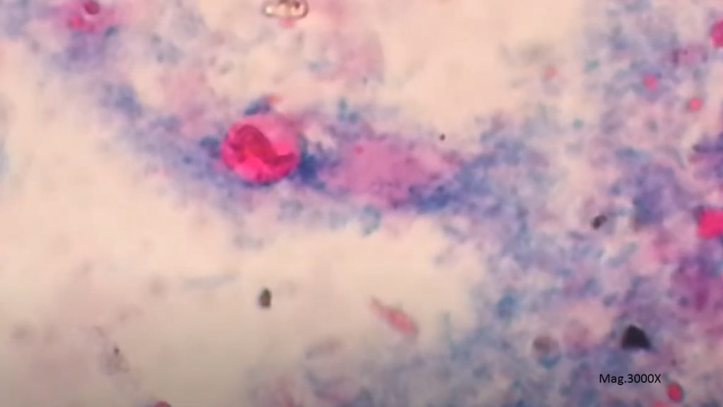 Cyclospora cayetanensis Oocyst in modified Acid Fast staining