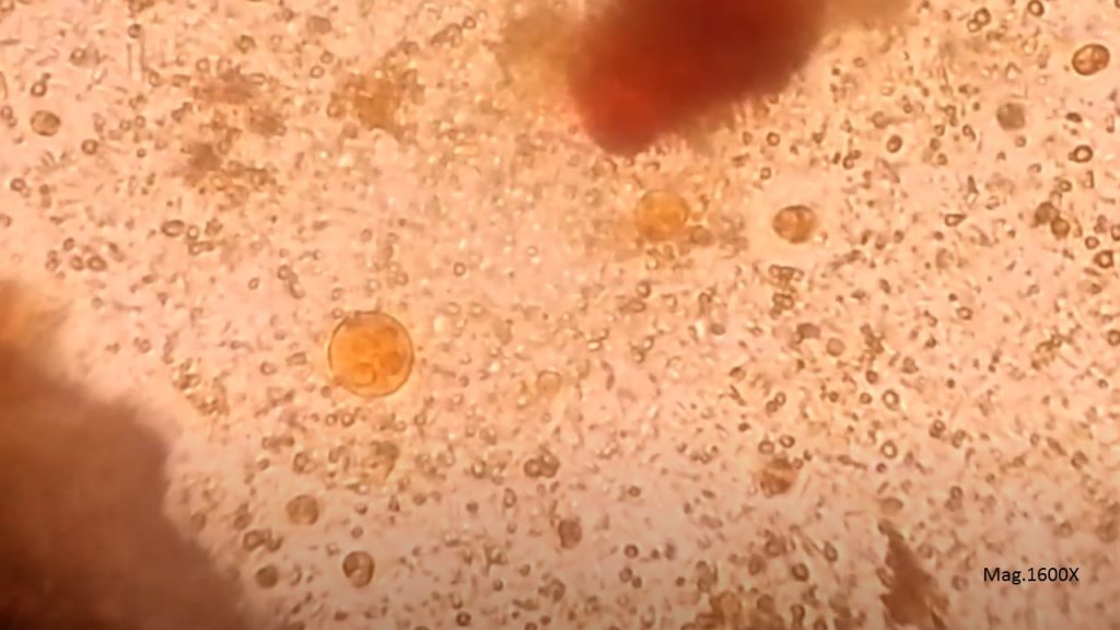 Cyst of Entamoeba histolytica/dispar in an iodine  wet mount microscopy