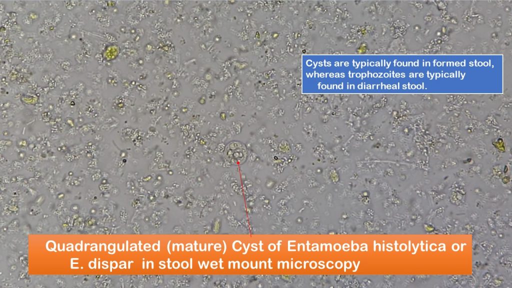 Cyst of Entamoeba histolyticadispar in a saline wet mount microscopy