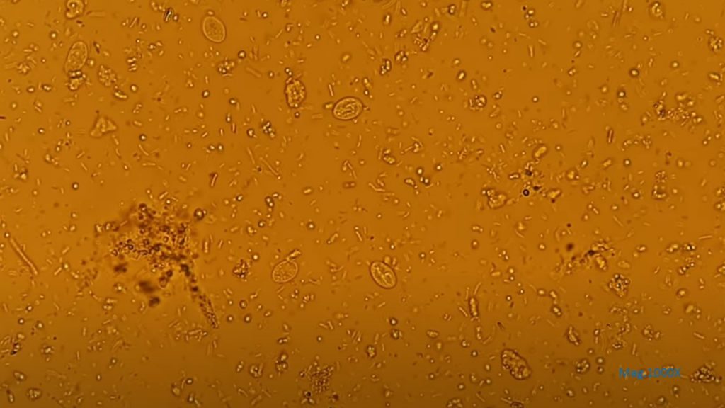 Cysts of Giardia lamblia in Iodine wet mount Microscopy