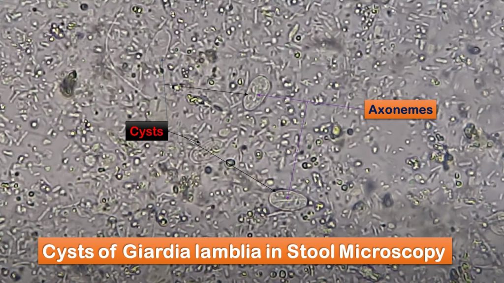 Cysts of Giardia lamblia in Saline wet mount of Stool Microscopy