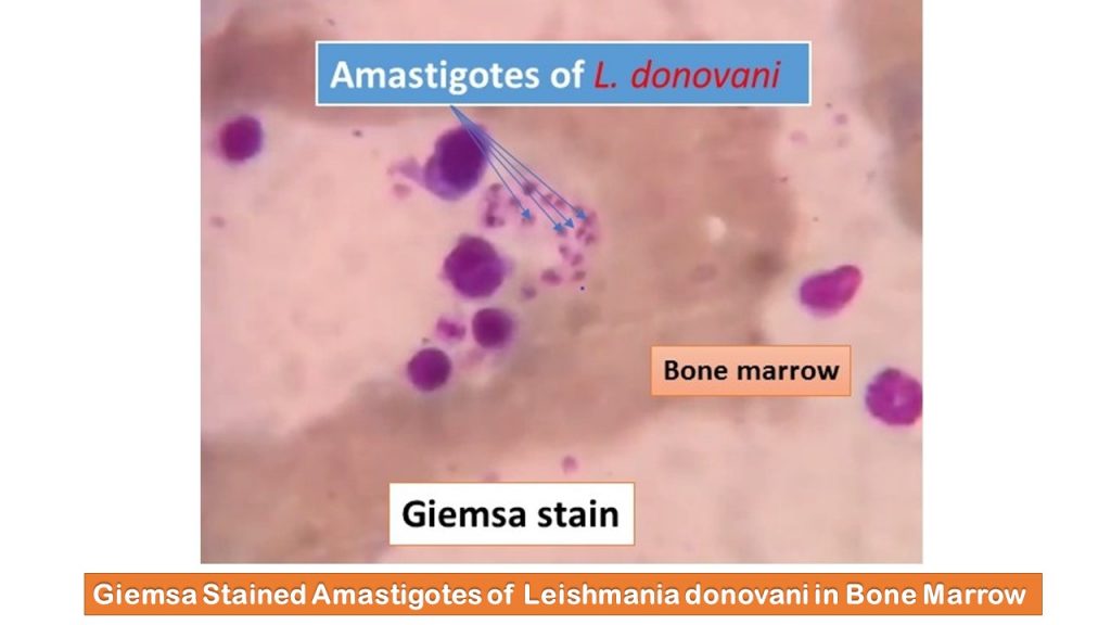 Giemsa Stained Amastigotes of Leishmania donovani in Bone Marrow