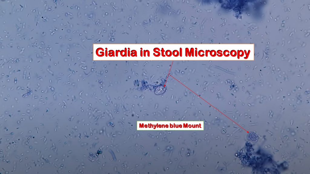 Methylene Blue wet mount of stool Microscopy showing cysts of Giardia lamblia 