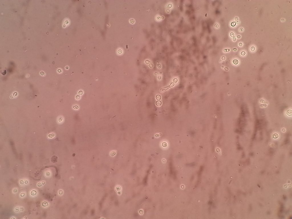 Nigrosin preparation showing Cryptococcus capsule