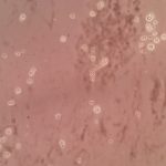 Nigrosin preparation showing Cryptococcus capsule