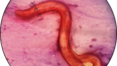 Rare case report from Gram stain of sputum showing Strongyloides : Introduction and impression