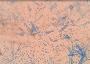 Trichophyton structures onLPCB