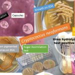 Cryptococcosis is an acute, subacute or chronic pulmonary meningeal mycosis  caused by Cryptococcus neoformans. It is a soil saprophyte and is particulary abundant in the faeces of pigeons( pigeon's dropping). It does not appear to infect birds, probably because of their high body temperature and infection through through out the world.