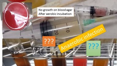 Anaerobic Infection: Importance, Indications, List of Anaerobic Bacteria