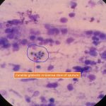 Candida glabrata in Giemsa stain of sputum