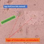 Egg of Enterobius vermicularis