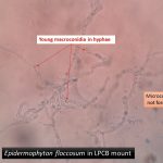 Epidermophyton floccosum in LPCB mount