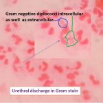 Gram negative diplococci in urethral discharge