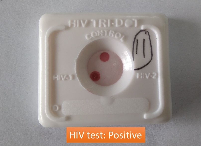 HIV test positive