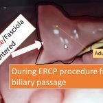 Liver fluke encountered from biliary passage