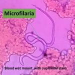 Microfilaria in blood wet mount