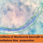 Microfilaria of Wuchereria bancrofti in methylene blue preparation