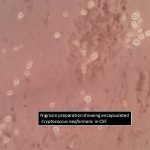 Nigrosin preparation showing encapsulated Cryptococcus neoformans