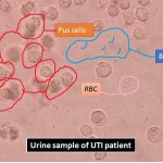 Pus Cell, Bacteria, and RBC in the Urine of UTI Patient: Introduction, Wet Mount Preparation and Related Videos
