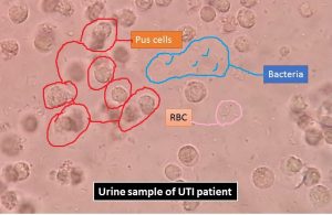 uti urine rbc