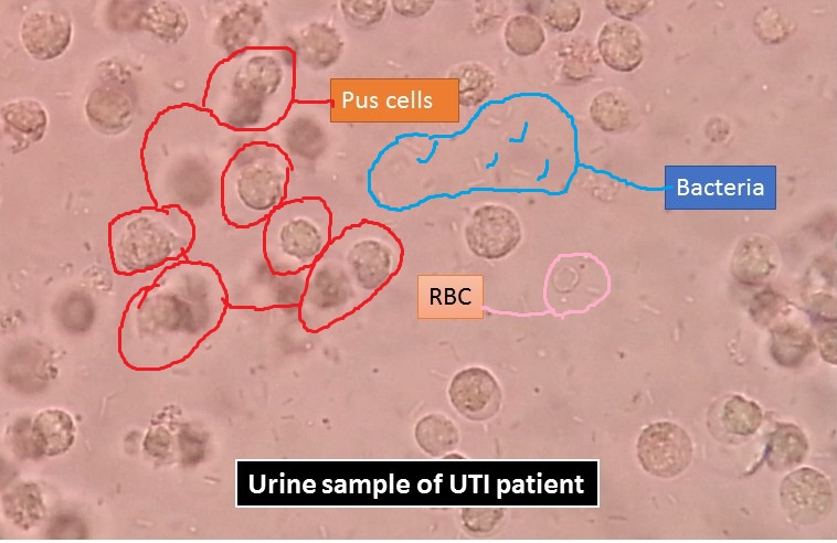 Pus Cell, Bacteria RBC in Urine of UTI Patient: Introduction, Wet Mount