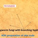 Rigworm fungi
