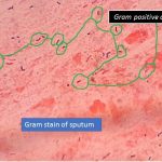 Streptococcus pneumoniae in sputum