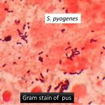 Streptococcus pyogenes in pus