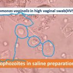 Trichomonas vaginalis in high vaginal swab (HVS)