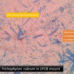 Trichophyton rubrum in LPCB mount