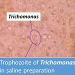 Trophozite of Trichomonas in stool