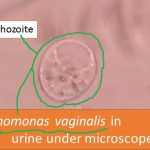 Trichomonas vaginalis in urine