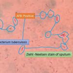 AFB stain of sputum showing AFB positive