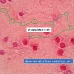 Acinetobacter in Gram stain of sputum