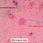 Bile Sample Gram Stain: Introduction, Procedure and Result Interpretation