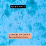 Blastocystis hominis in Sargeaunt's stain of stool