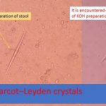 Charcot Leyden crystal