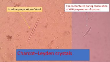 Charcot Leyden crystal