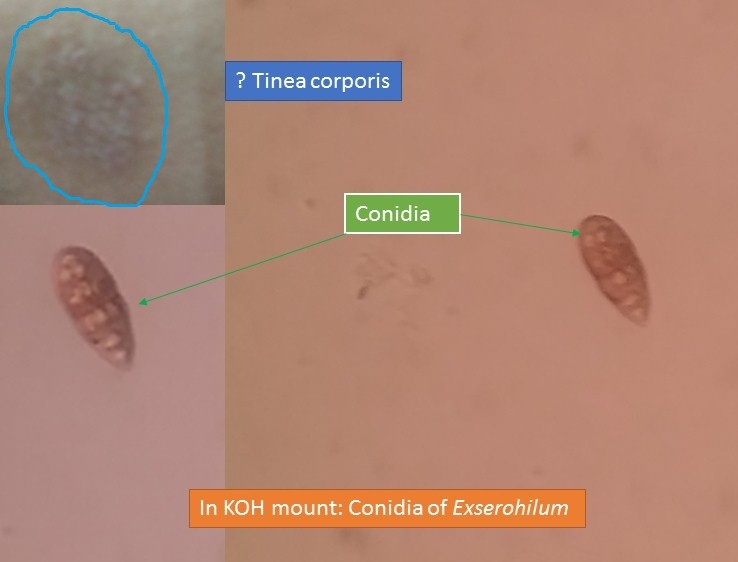 Conidia of Exserohilum