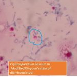 Cryptosporidium parvum in Kinyoun's stain of diarrhoeal stool