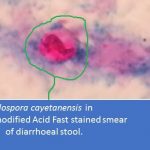 Cyclospora cayetanensis in modified acid fast stained smear of diarrhoeal stool